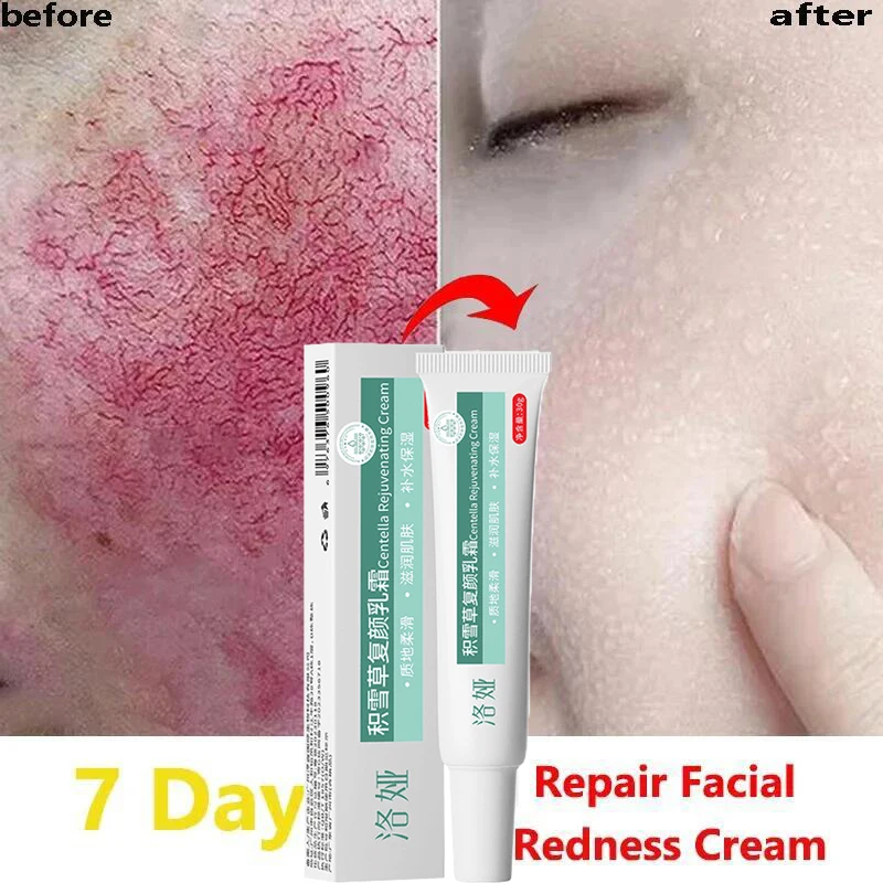 Fast Repair Facial Redness Cream Sooth Itching Sensitive Skin Improve Rosacea Remove Acne Nourish Facial Skin Korean Cosmetics