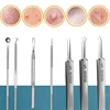 11Pcs Acne Needle Blackhead Clip Remover Extraction Pore Black Head Clean Face Skin Care Cleansing Needle Blemish Removal Tool 3