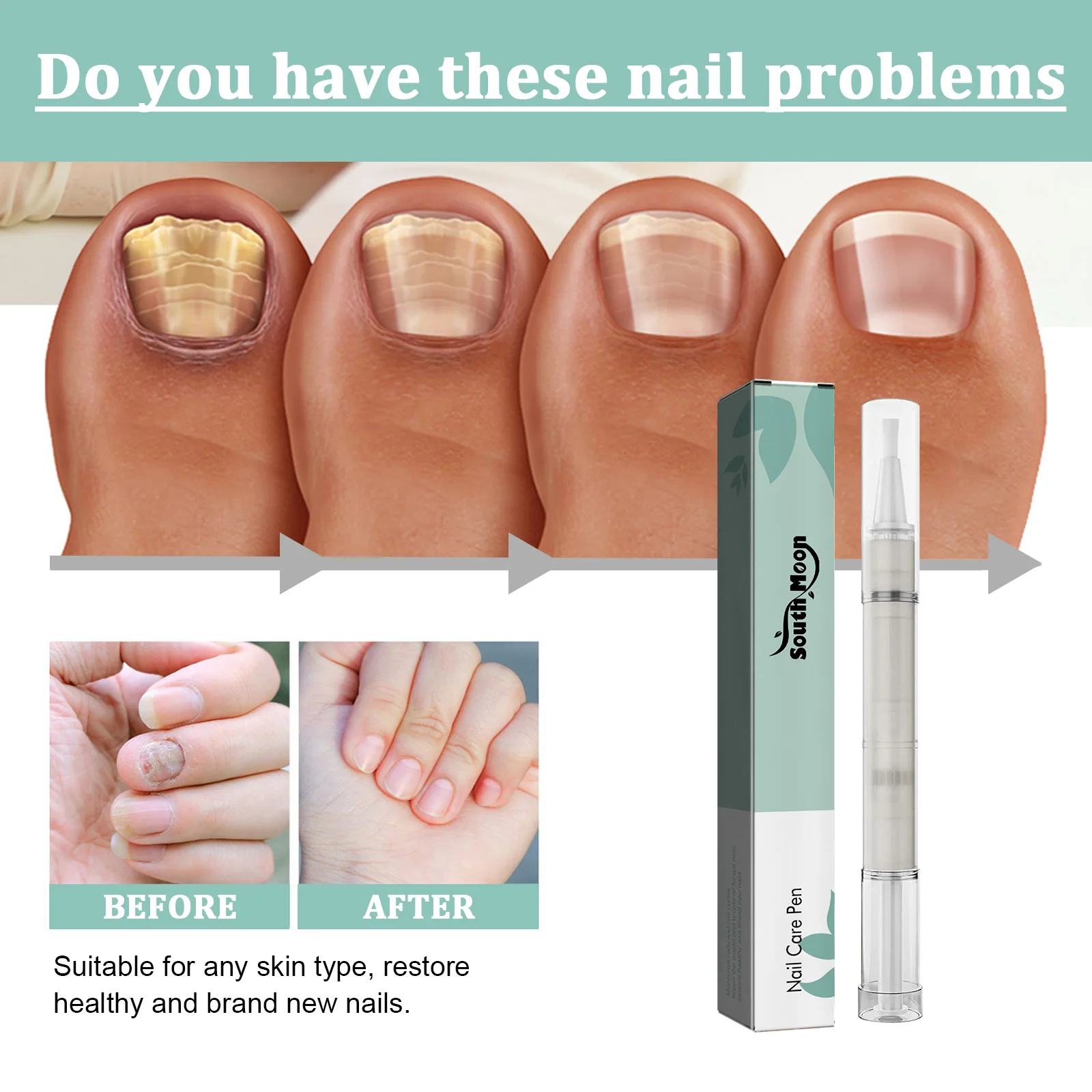 Probelle Natural Fungal Nail Treatment, Anti Fungal Nail Treatment, Nail  Color Restoration, Clear.5 oz/ 15 ml (Patented Formula) : Amazon.ca: Beauty  & Personal Care
