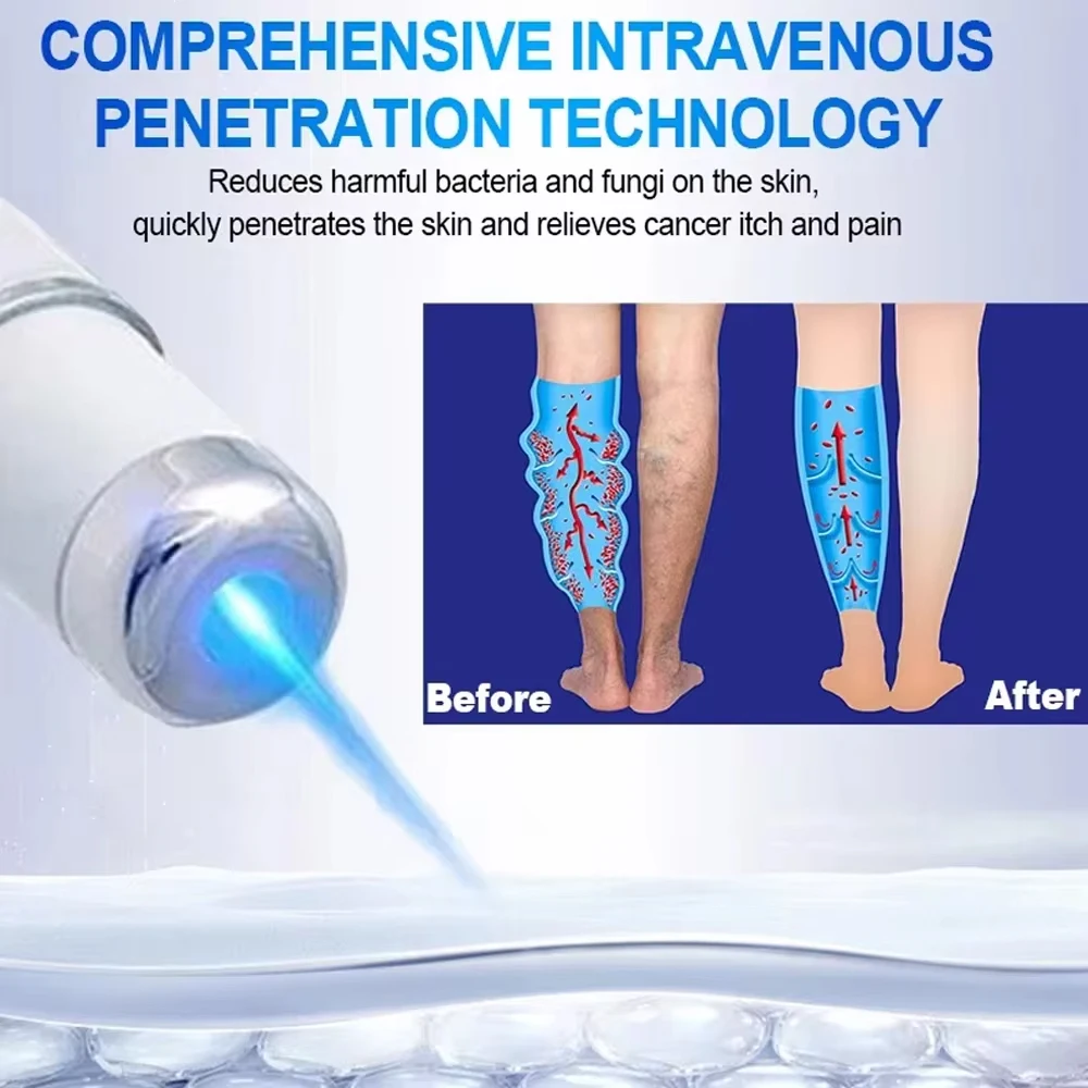 Varicose Veins Laser Treatment Cream Effective Relieve Legs Dilated Vasculitis Phlebitis Natural Formula Ointment Varicose Veins