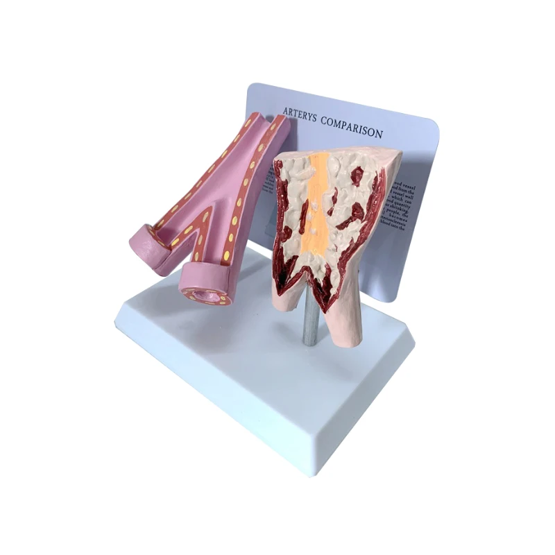 

1:1 Vascular Model of Smoking Arteries Comparison Smoking Vessels and Normal Vessels Model Human Vascular Medical Teaching Model