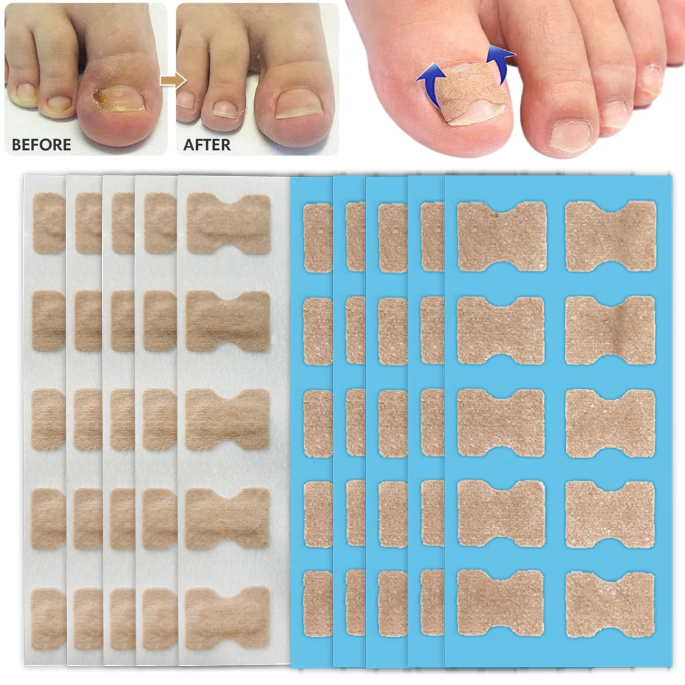 10/50/100pcs Ingrown Toenail Toe Correction Stickers Nails Art Foot ...