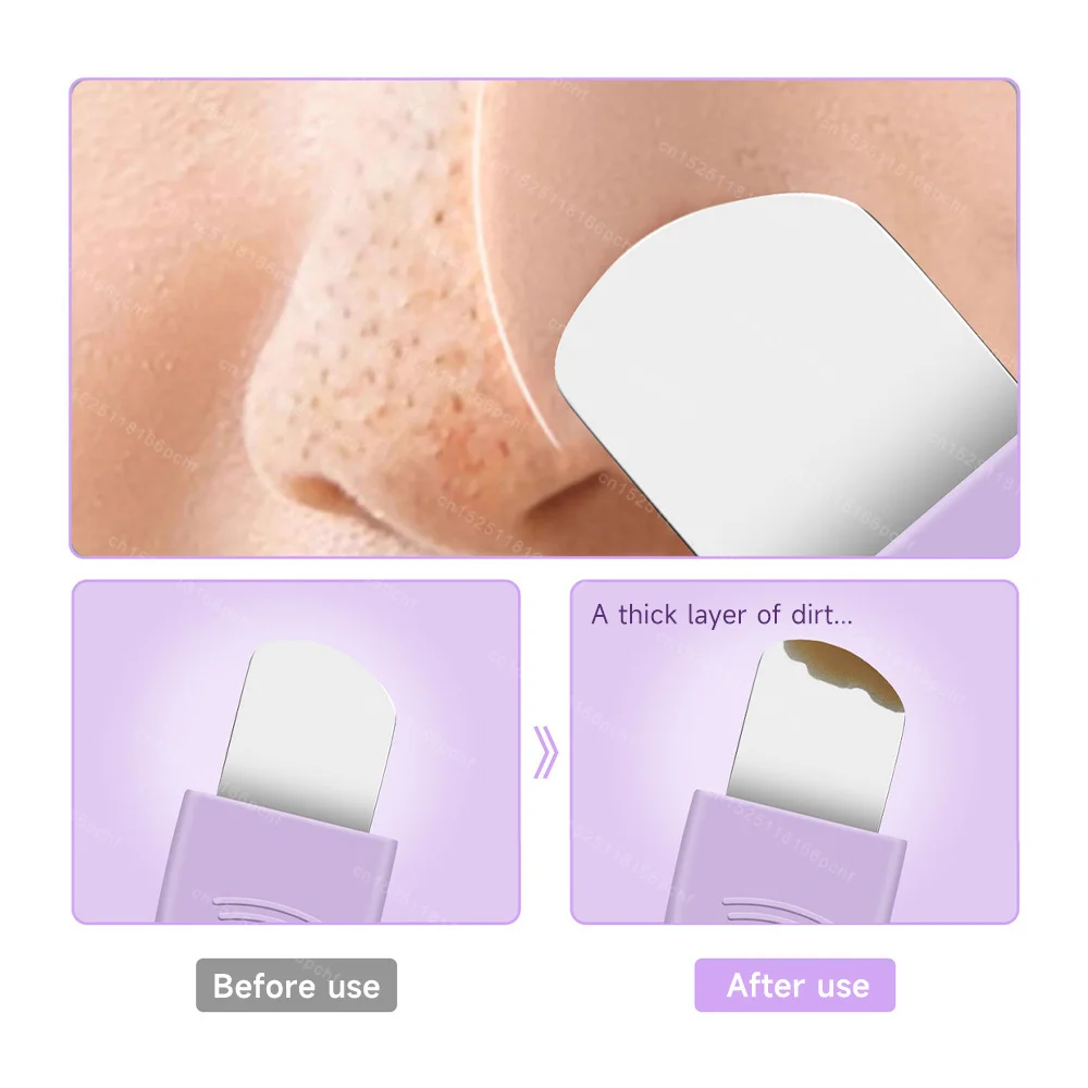 Facial Blackhead Removal Kit Facial Cleansing Remove Pimples and Blemishes Gentle Pore Clean Exfoliating Acne Removal