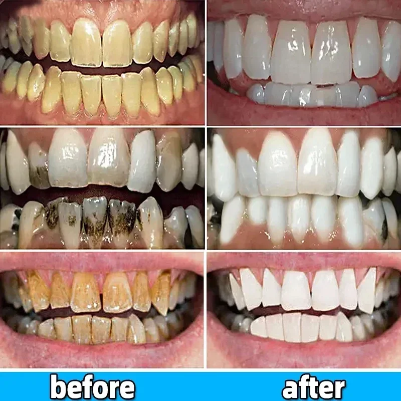 Dental Calculus Remover Toothpaste Preventing Periodontitis Cleansing Care