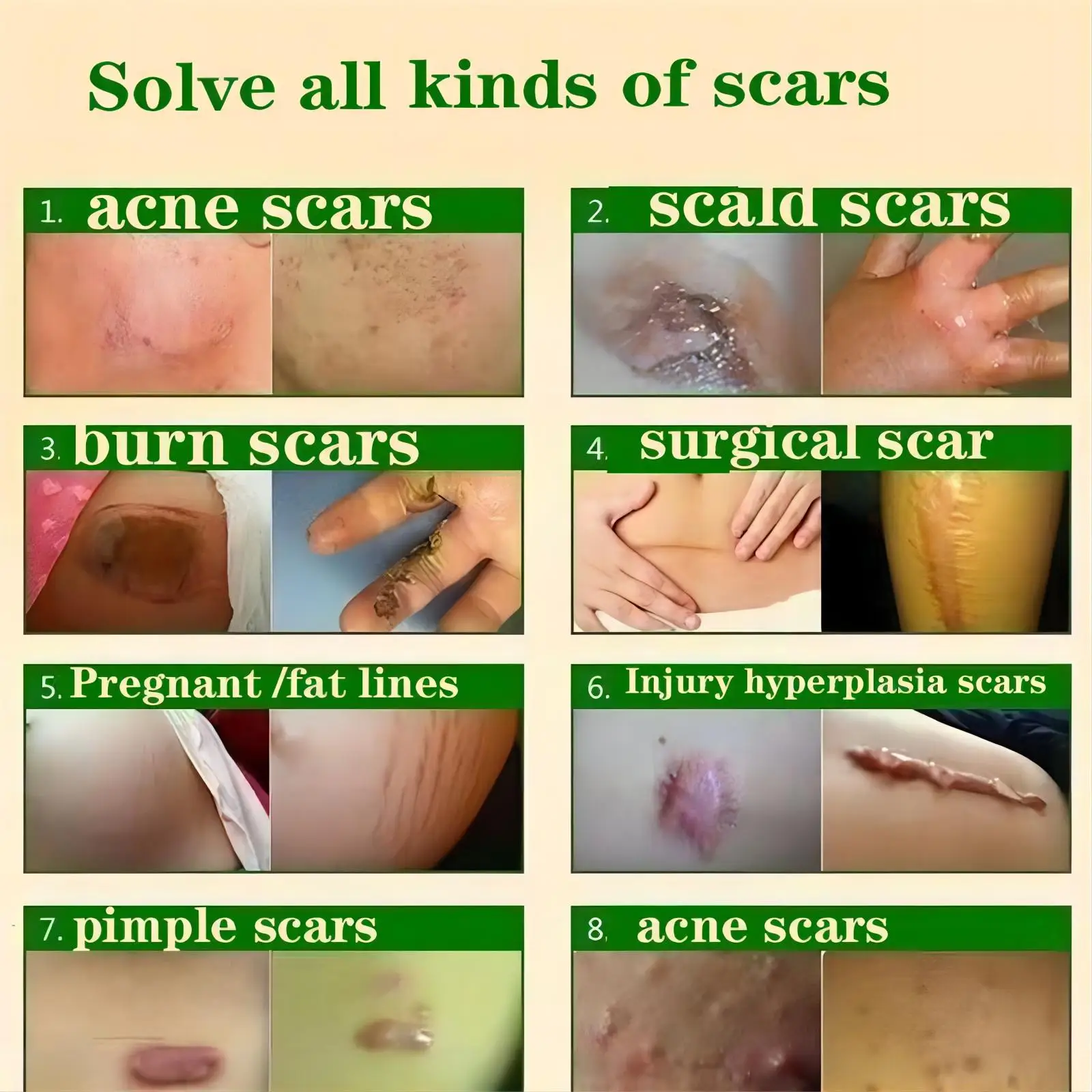 Chickenpox scar removal: Treatments and home remedies