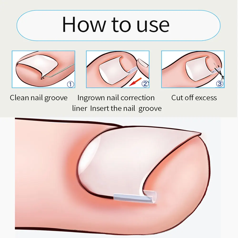 Ingrown Nail Corrector 12/24pcs C-shaped Filling Pad For Nail Inlay Pedicure Correction Tool