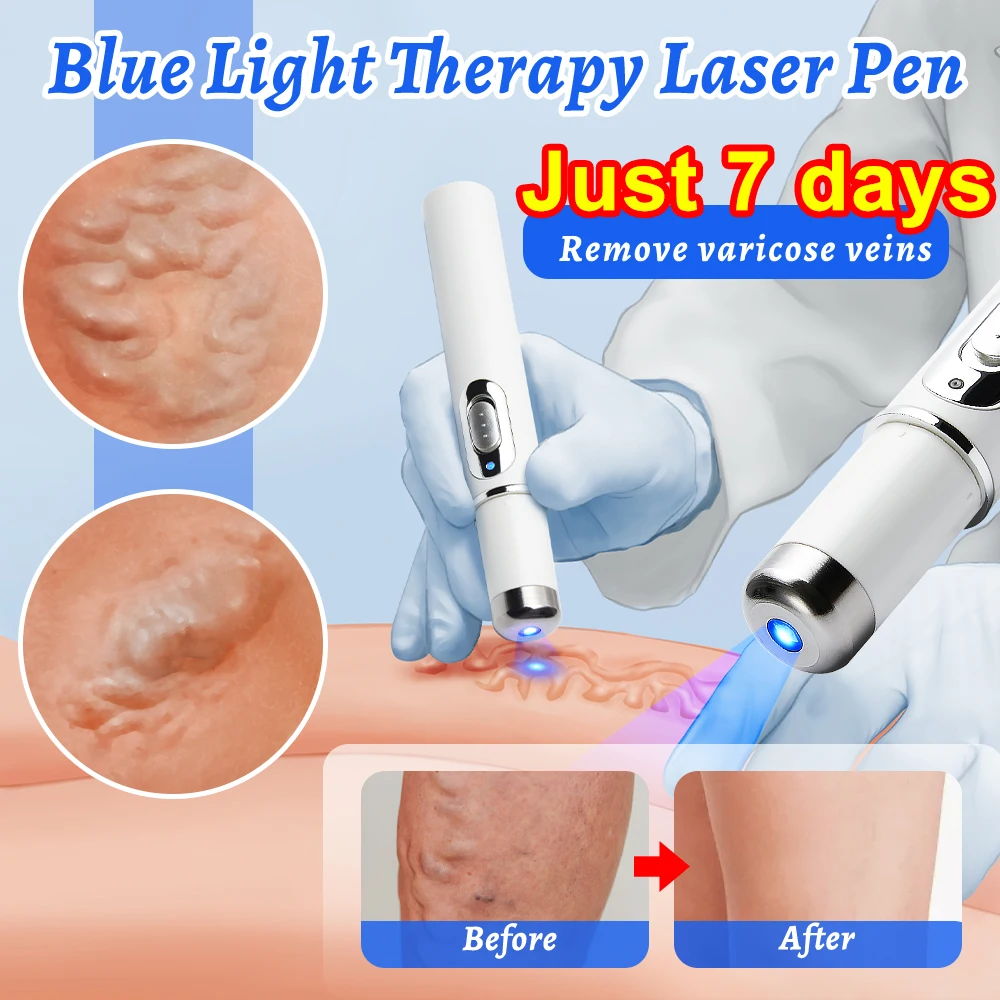 Varicose Vein Lampshade Therapy Effective Improved Blood Circulation Relief of Dilated Vasculitis In The Legs Phlebitis