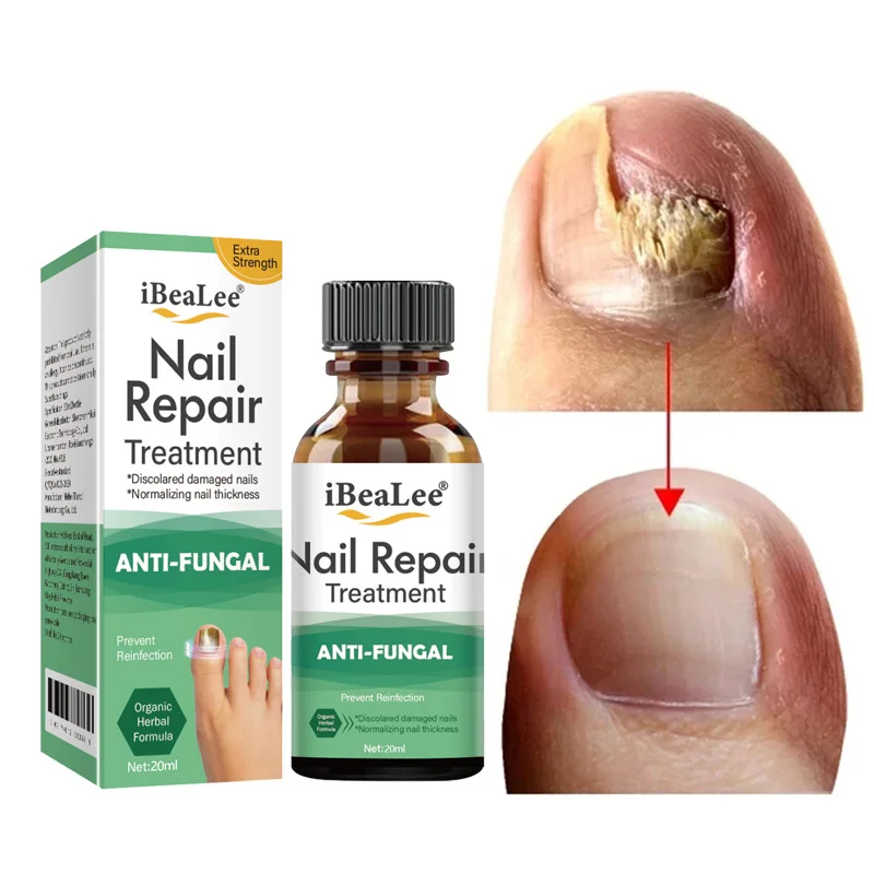 

Nail Fungal Treatment Feet Care Essence Nails Foot Repair Toe Nail Fungus Removal Oils Anti Infection Paronychia Onychomycosis