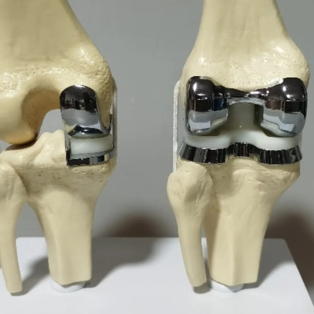 Detachable Artificial Knee Prosthesis Model Small Double Silver Knee Joint Implant Model Set