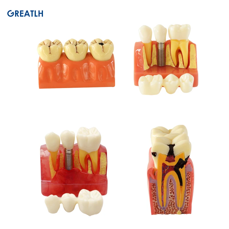 

Dental 4Times Caries Disassembling Model Implant Model Dental Demonstration Teeth Model