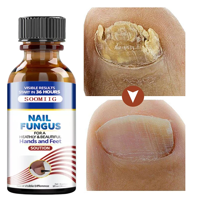 Nail Fungus Treatment Serum Hand & Foot Care Fungus Removal & Repair