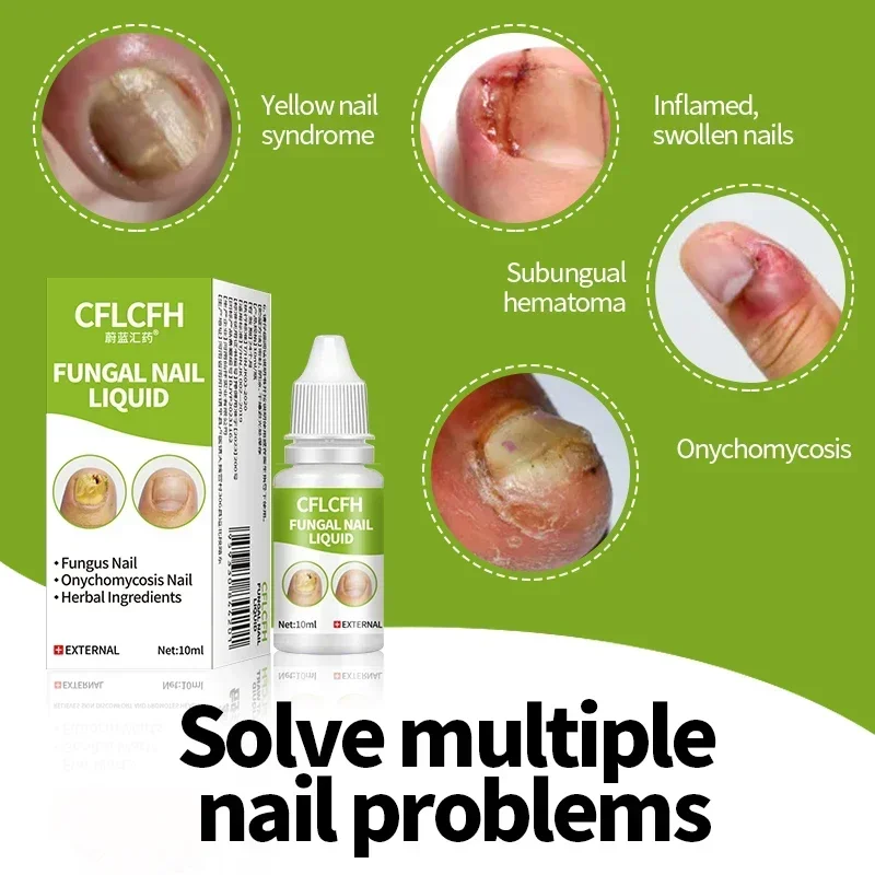 Nail Fungus Treatment Oil Onychomycosis Repair Removal Paronychia Foot Toe Toenail Nail Fungal Repair Care Liquid