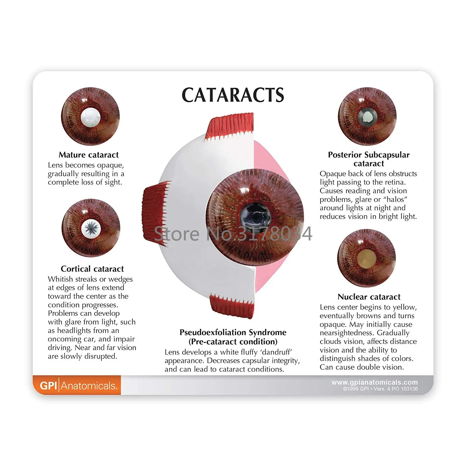 Human Cataract Eye Anatomical Model – Anatomy Replica of Normal Eye Educational Medical Tool for Doctor’s Office 3