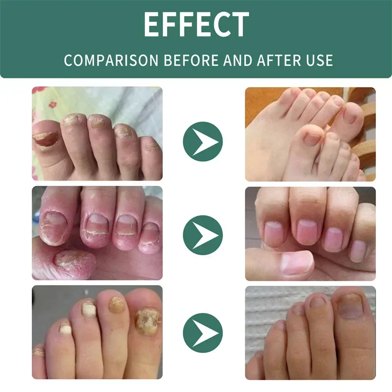 Beauty Health Nail Fungus Treatment Anti-Infection Nail Fungal Removal Essence Nails Fungus Treatments Serum Spray Repair Toe