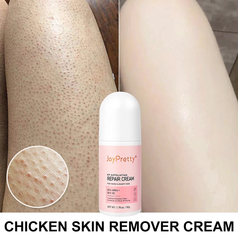 

60g Chicken Skin Body Cream Rough Bumpy Pore Spots Care Removal Treatment Keratosis Pilaris Lotion Moisturizer Whitening Creams