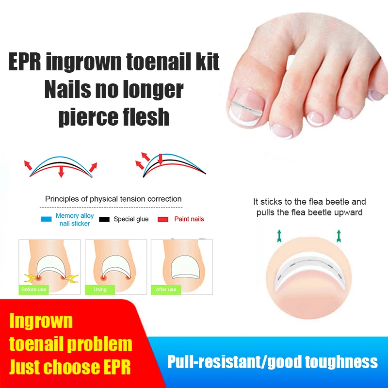 25/30Pcs 13-19mm Nail Correction Stickers Ingrown Toenail Corrector Patches Paronychia Treatment Recover Care Pedicure Tools