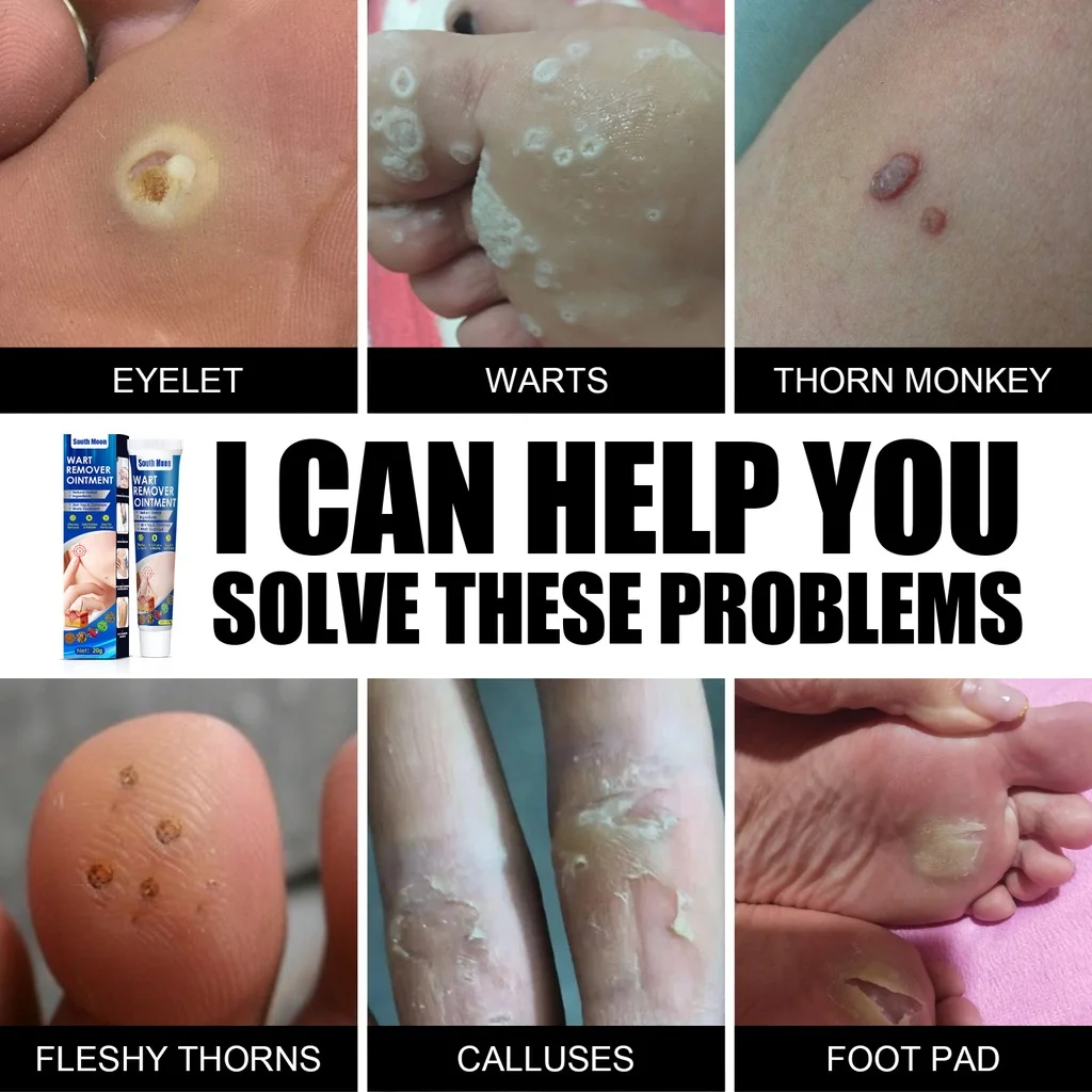 Vinegar Wart Treatment