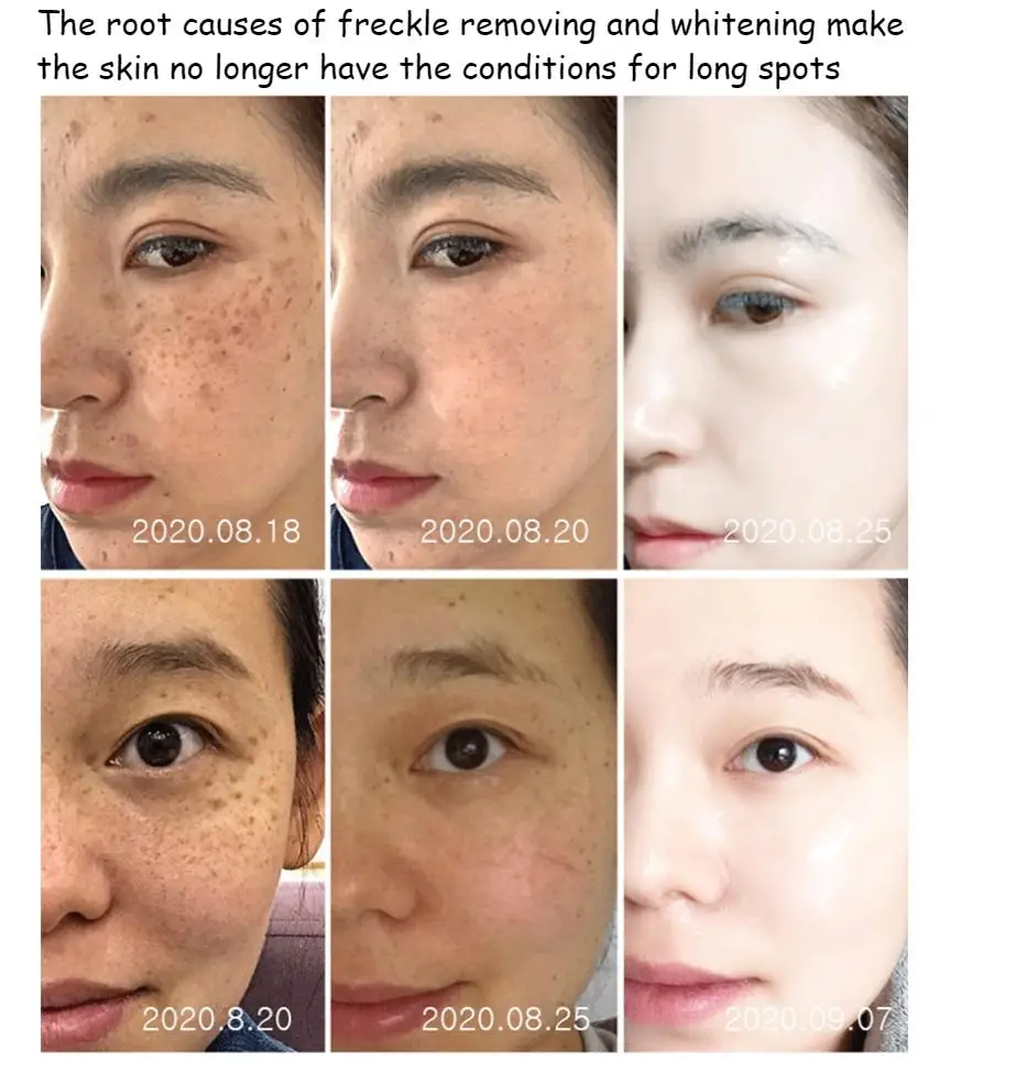 377 whitening cream VC cream freckles chloasma senile plaques beauty salons yellowing control