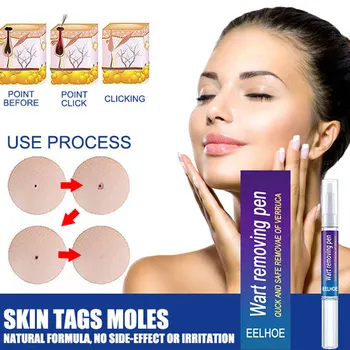 Wart Removal Mole Remedy Liquid Pen Treatment Papillomas Removing Skin Labels Flat Wart Genitals Painless Beauty Herbal Cream 2