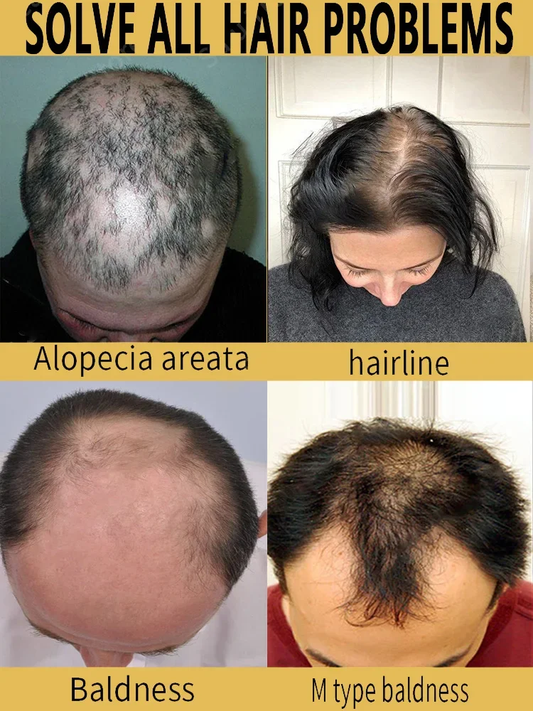 Fast Hair Growth Oil for Biotin Fast Treatment Baldness Serum Hair Growth Oil for Black Women Hair CareTreatment beauty products