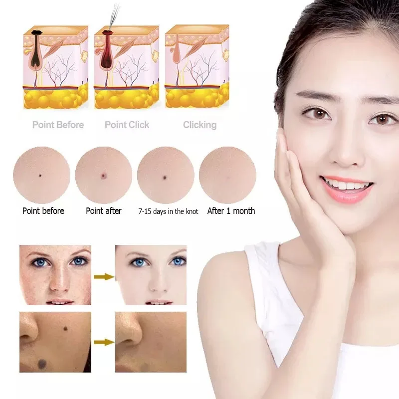 Electronic Plasma Pen Laser Facial Freckle Dark Spot Wart Mole Removal Beauty Machine skin tag removal tool skin tag removal pen laser skin treatment