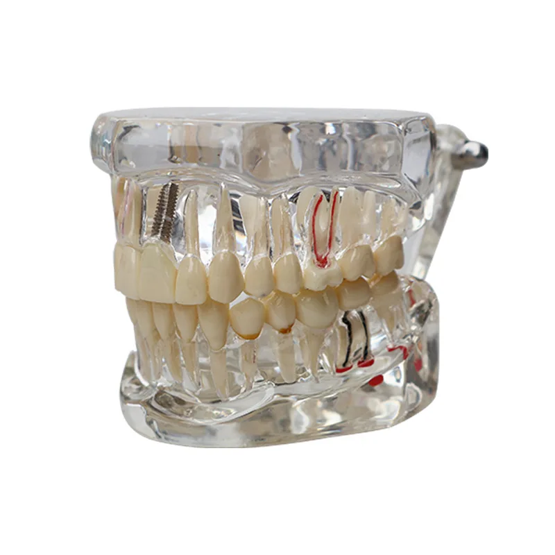 탈착식 치과 임플란트 복원 교육 모델, 의사-환자 의사소통 시뮬레이션 의료 교육 도구