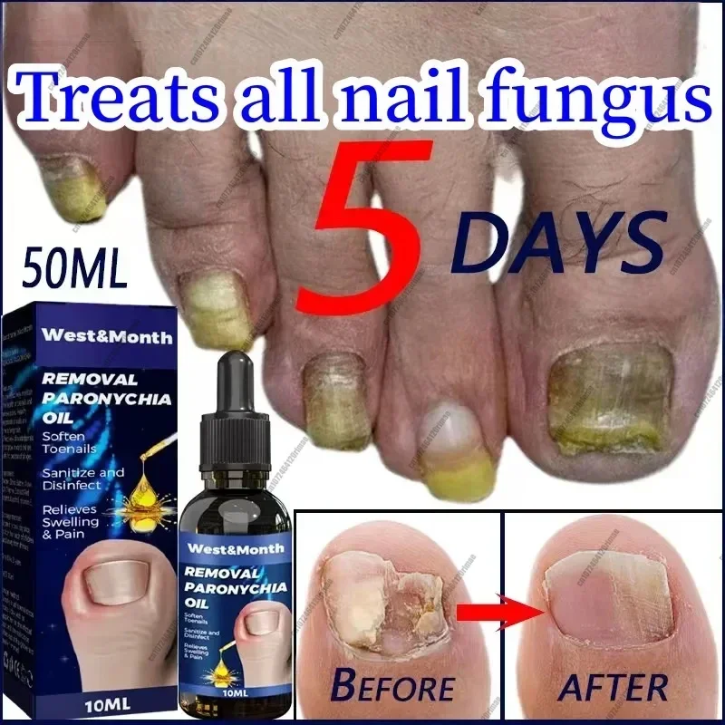 Fast Onychomycosis Fungus Nail Repair