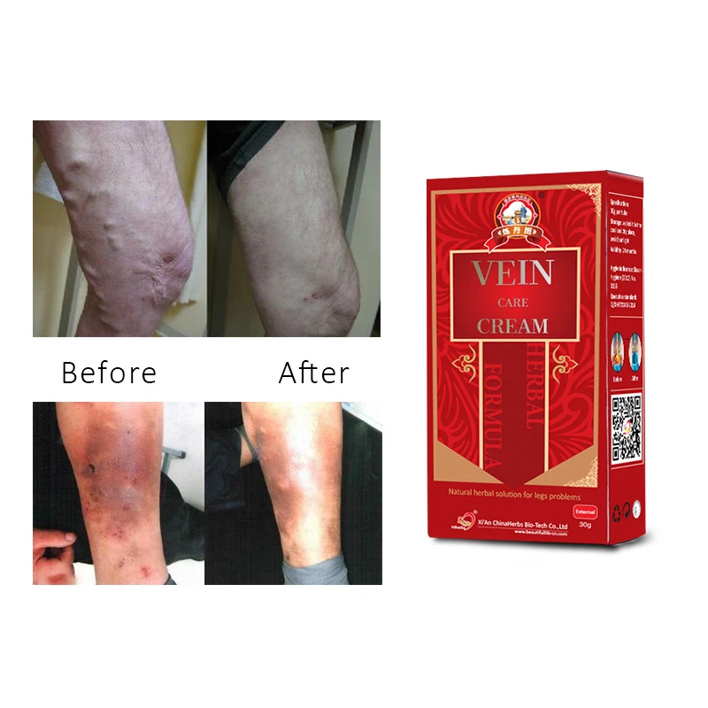 2 Packs Vasculitis Ointment Old Bad Leg Earthworm Lumps Cream Varicose