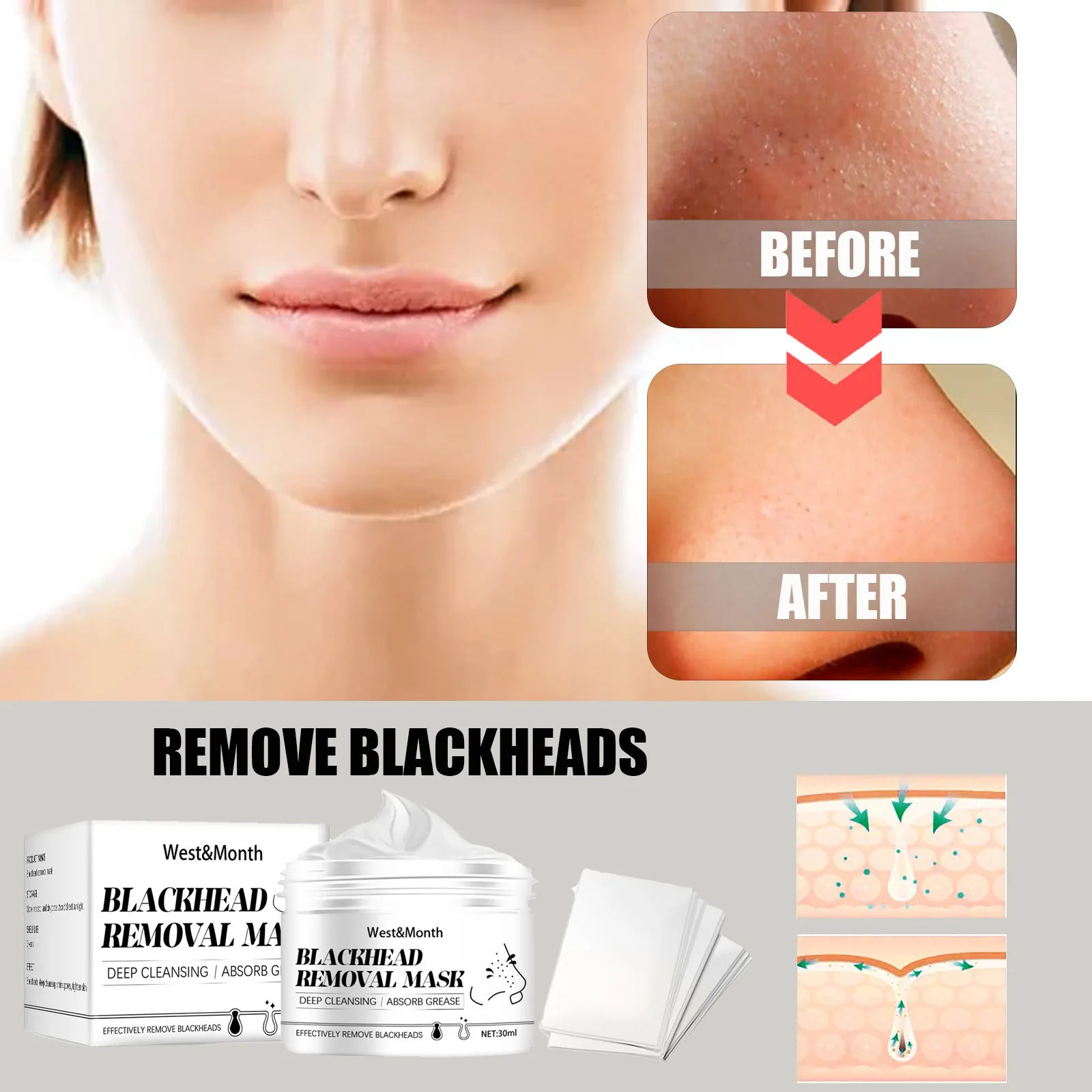 New deep blackhead removal video