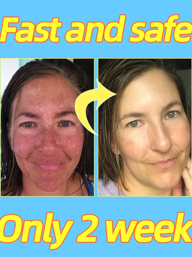 Creme De Remoรงรฃo De Mancha Escura, Melasma, Chloasma, Sardas