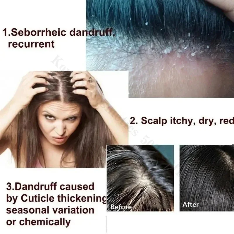Hair Essence Oil Hair Oil Hair Growth Oil Anti Dandruff Hair Oil Control Relieve Itching Treatment Scalp Cleaning Exfoliating Product Antipruritic Anti Loss Hair
