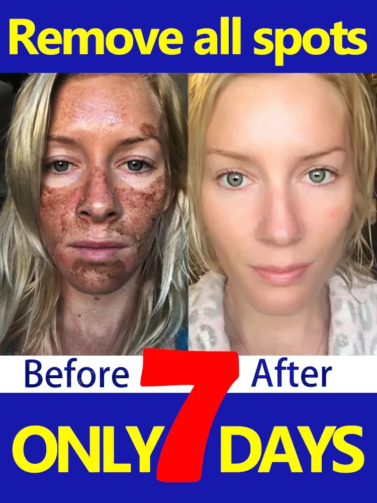 

Dark Spot Remover for Face Removing Freckle Chloasma Senile Plaques Sunburn Cyasma Chorioplaque Freckle Cream Light Dark Spots