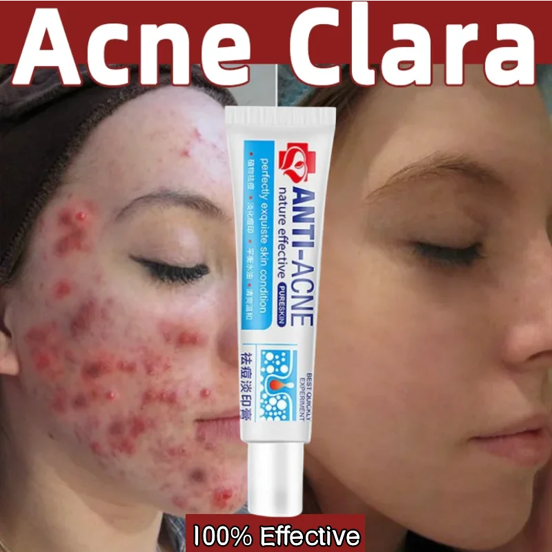 

Effective Acne Removal Face Cream Oil Control Anti Acne Scars Treatment Gel Shrink Pores Moisturizing Brighten Beauty Skin Care