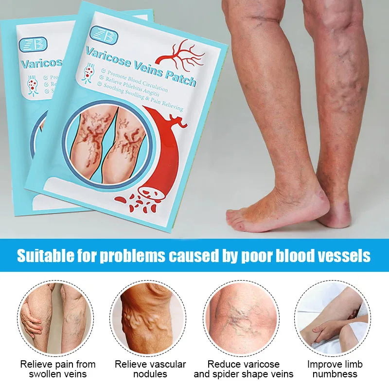 Varicose vein patch for treatment of varicose muscle vasculitis alleviating muscle swelling pain 6pcs=1bag