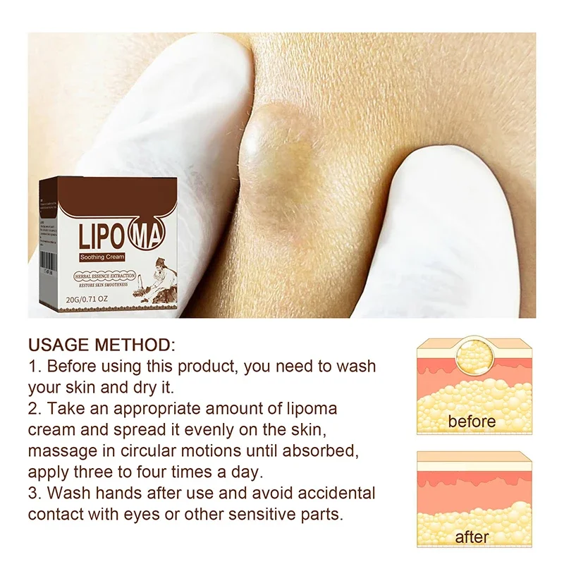 Subcutaneous Lump Removal Soothing Cream Is Suitable For Eliminating Fat Lumps And Reducing Fat Lumps It Is A Body Health Cream