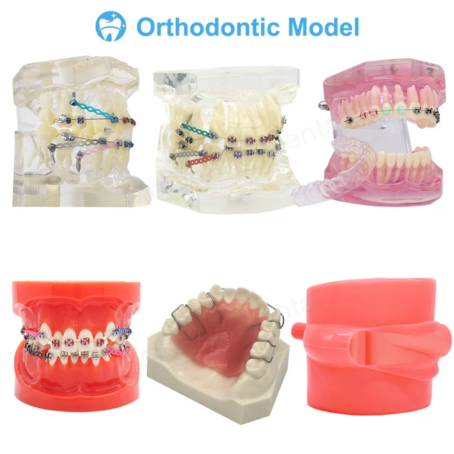 prothèse amovible differents appareil dentaire