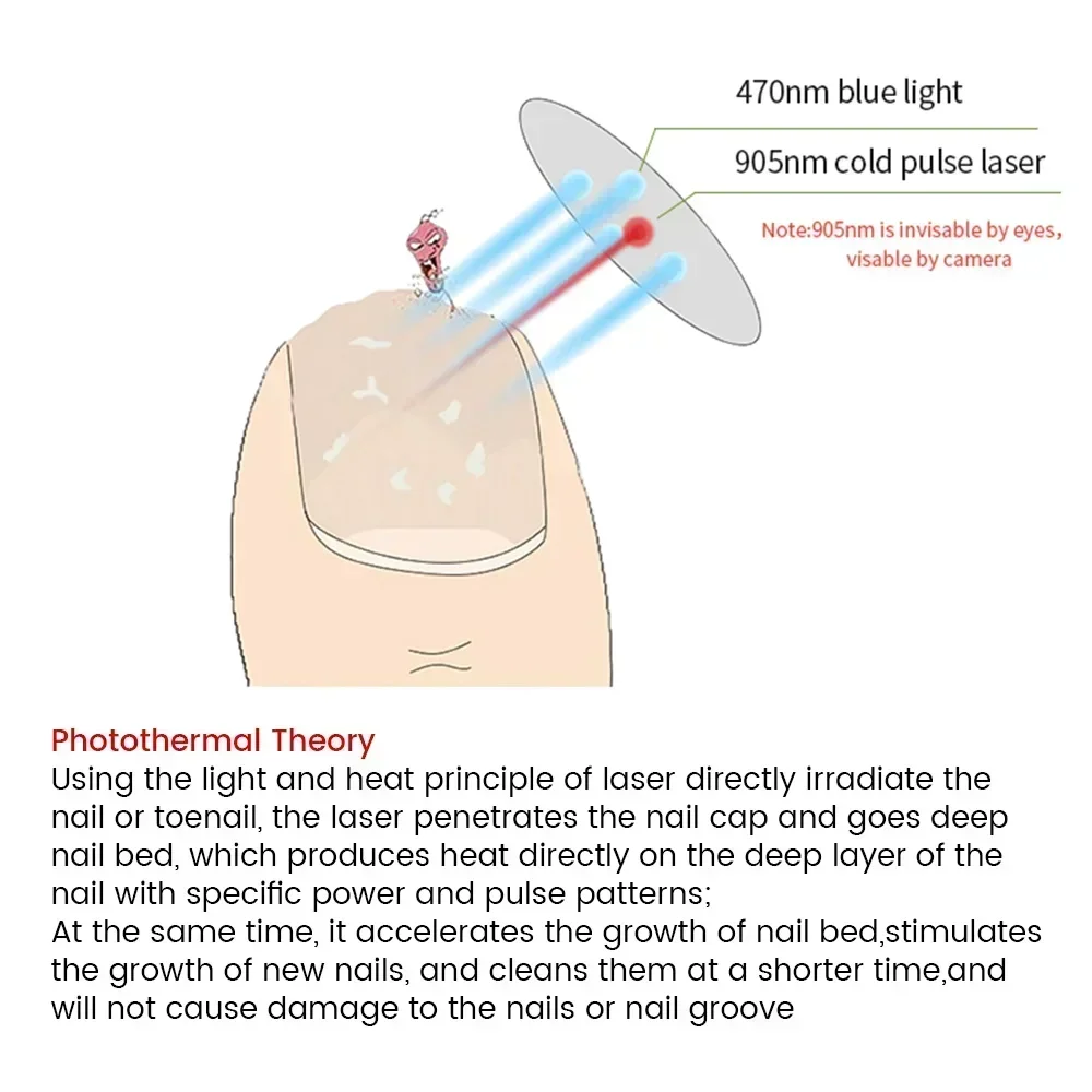 Nail Fungus Laser Treatment Device for Toenail Fingernail Fungus Treatment Strength Treat Onychomycosis Toe Cure Machine