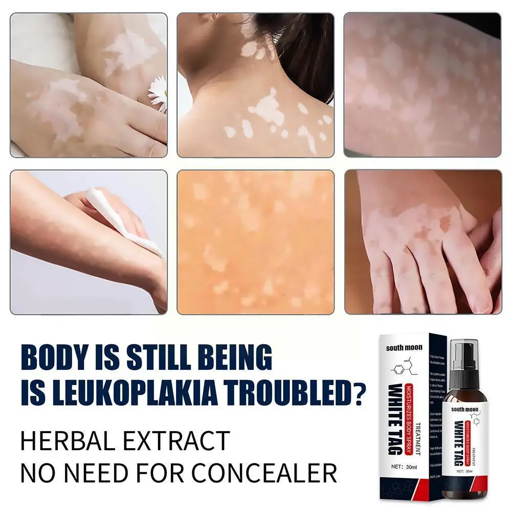 Vitiligo treatment cream Vitiligo relief spray Skin treatment lamp White Spot Removal vitiligo ointment Eliminate vitiligo ointment
