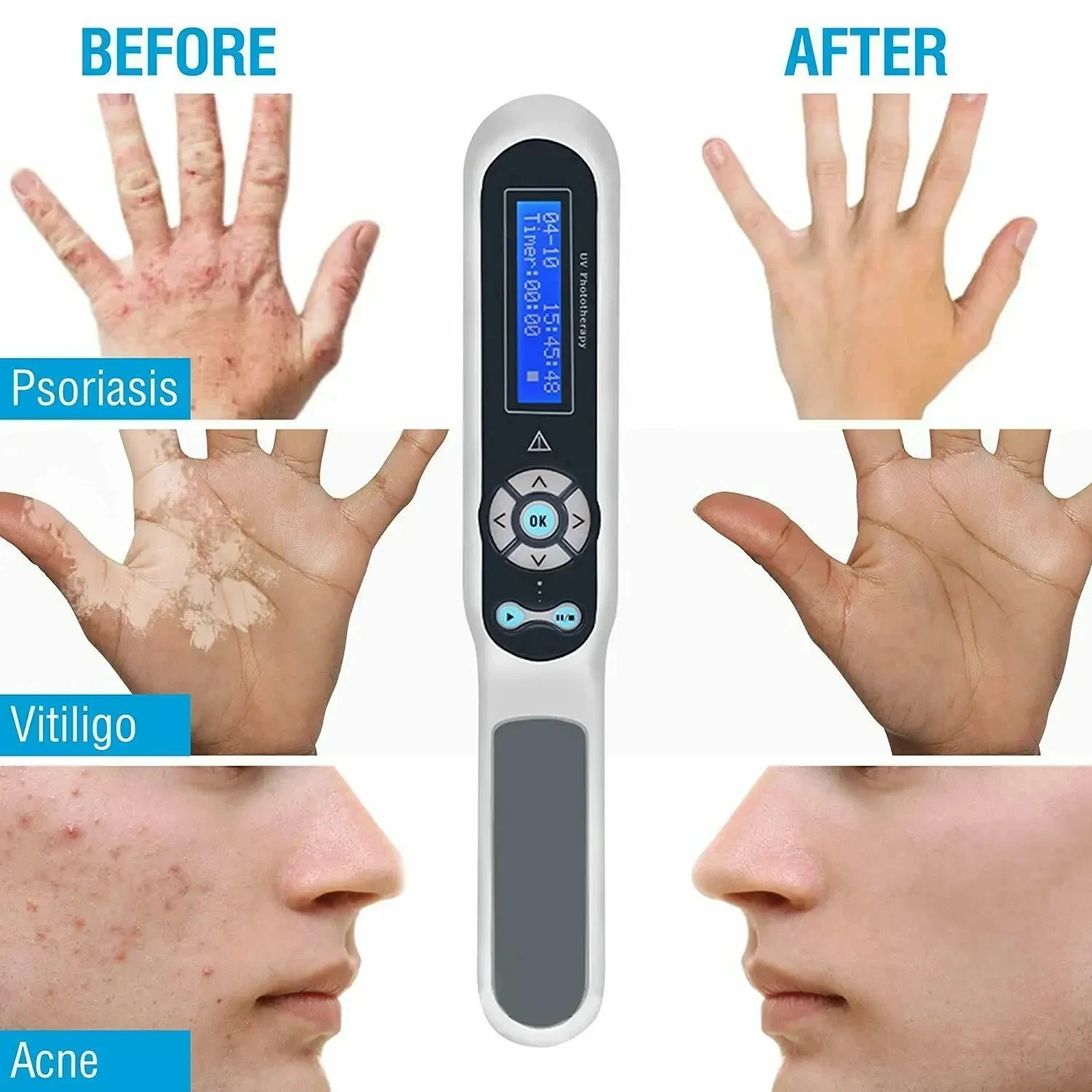 308nm Handheld uvb Light Therapy Portable Effective To Treat vitiligo Psoriasis Eczema Uvb Lamps Uv Phototherapy Instrinstrument 3