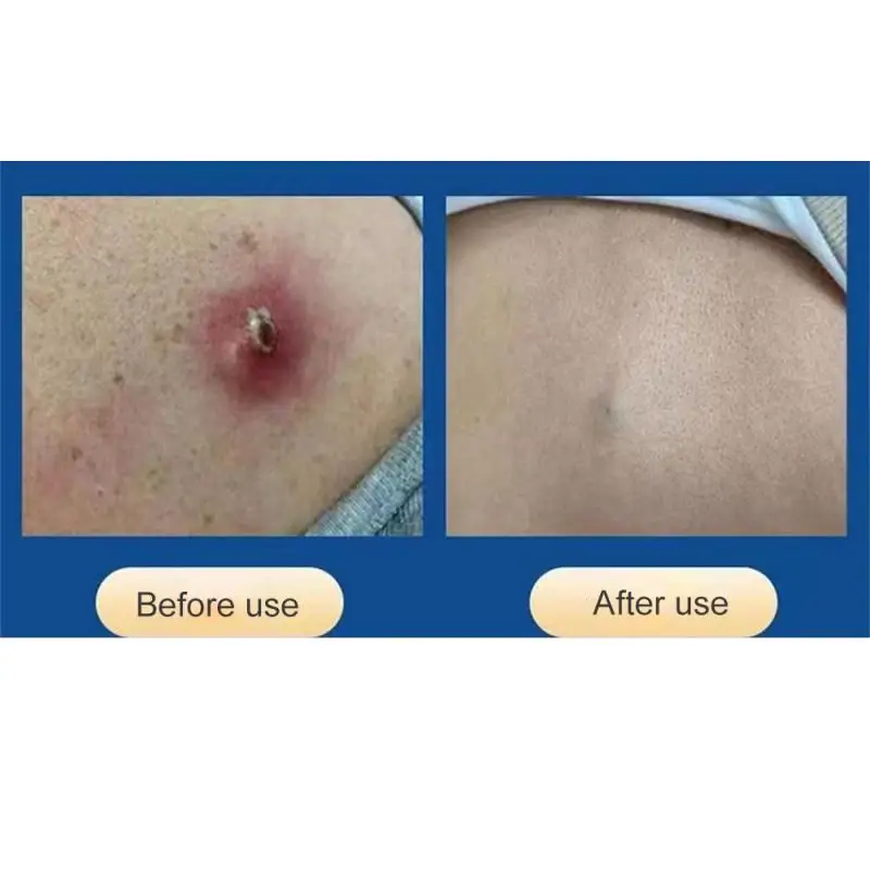 Lipoma Removal Cream 20g Relief Pain Treat Skin Swelling Lipolysis Cellulite Remover Ointment Body Care