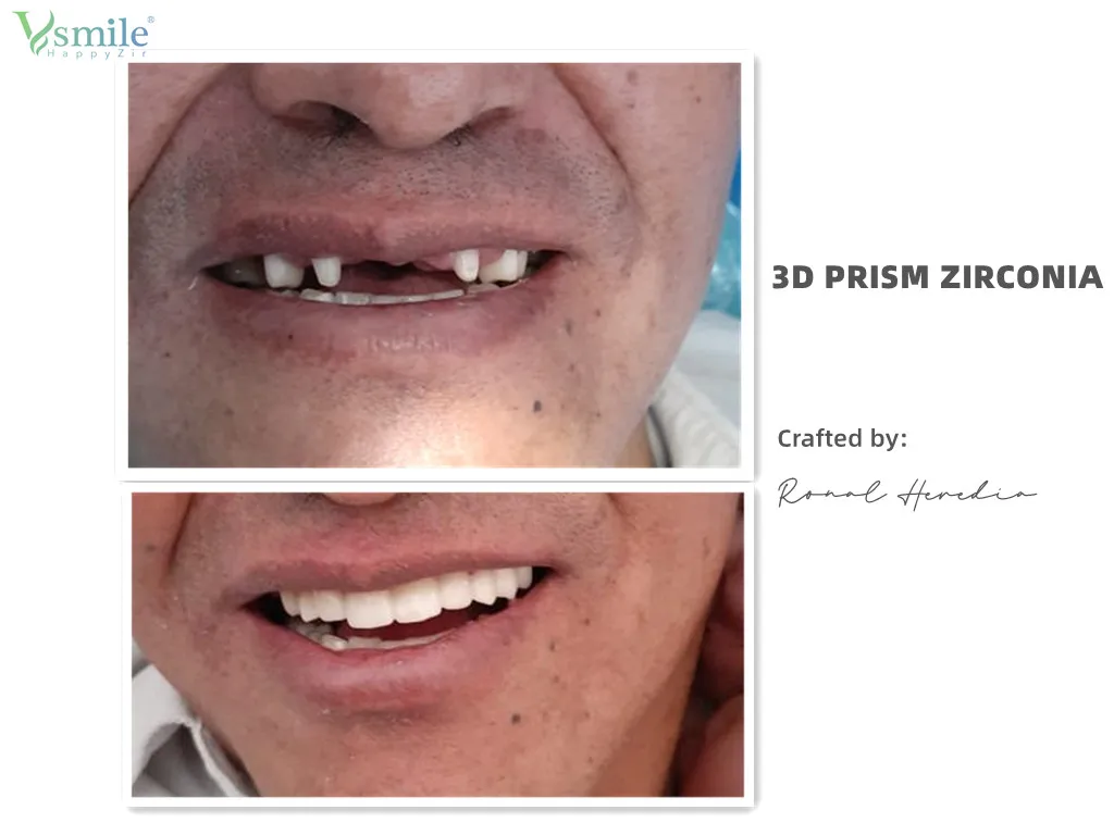 98/95/Amann 3D Prisma Multilayer Zirkonia Block Prothese 1200MPA 43-57% CADCAM Zirkonoxid Disc für Dental Labor Crown Long Bridge – Detail 7