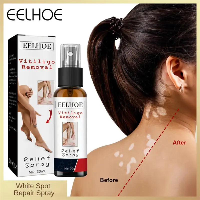

White Spot Vitiligo Treatment Spray Moisturizing Reduces White Spots Leukoplakia Disease Pigment Melanin Repair White Tag Care