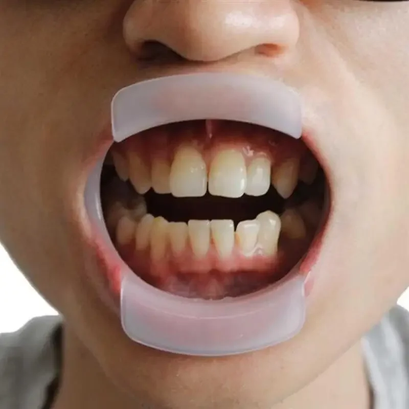 5 stücke Dental O-Form Mund Opener Kieferorthopädische Lip Wange Retractor Zahnmedizin O Typ Mund Expander Zähne Behandlung Pflege werkzeug – Detail 5