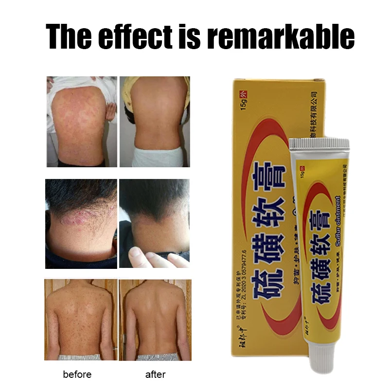

10pcs 15G Sulfur Cream Treat Dermatitis Psoriasis Ointment Eczematoid Skin Repair Care Balm Antibacterial Antipruritic Dressing