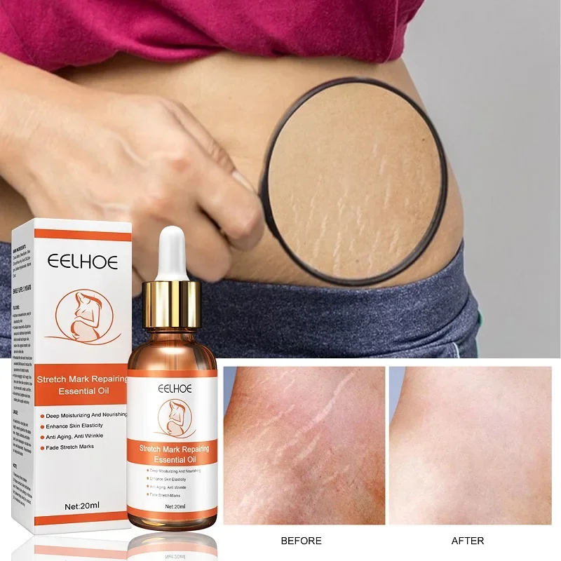 Stretch marks cream Stretch Marks Repair Essential Oil Skin Care Treatment Cream for Maternity Remover Anti-Wrinkle Slackline for Pregnant Oils 20ml