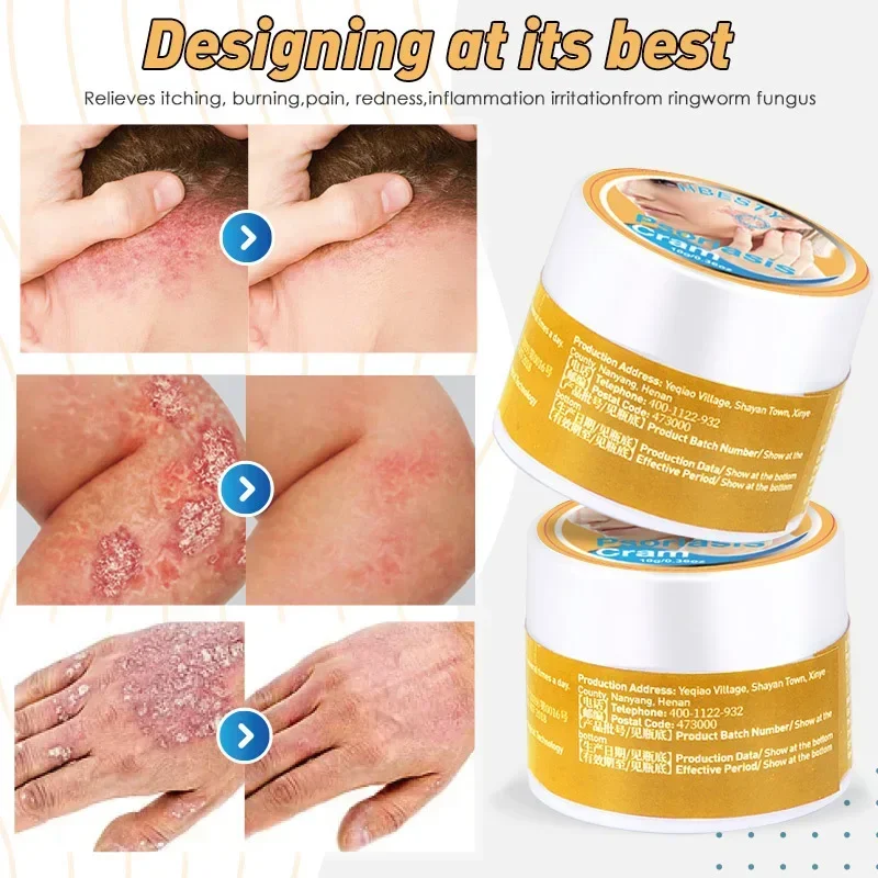 Herbal Anti-itch Psoriasis Treatment Ointment Eczema Hand Foot Tinea Against Fungi Itching Dermatitis Skin antipruritic Cream