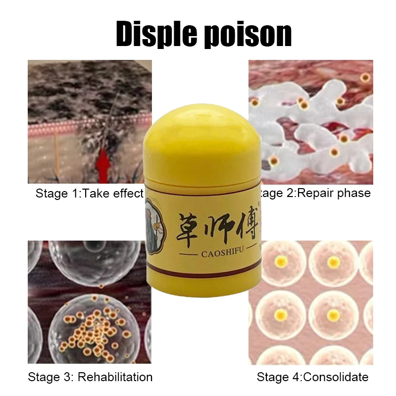 Natural Psoriasis Ointment Treat Dermatitis Eczema Antipruritic Dressing Eczematoid Skin Repair Antibacterial Cream 4pcs 10g