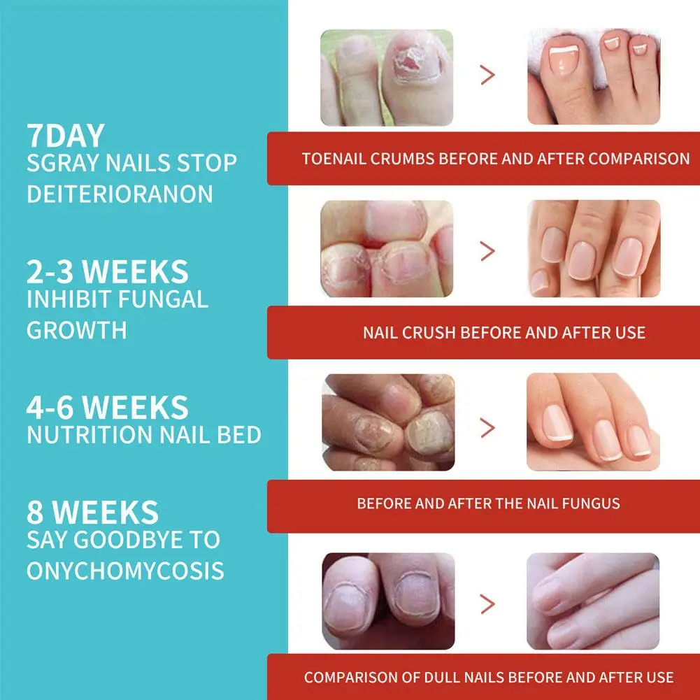 Nail Fungus Remover Toenail Fungus Treatment Nail Patches Anti Fungal Nail Correction Patch
