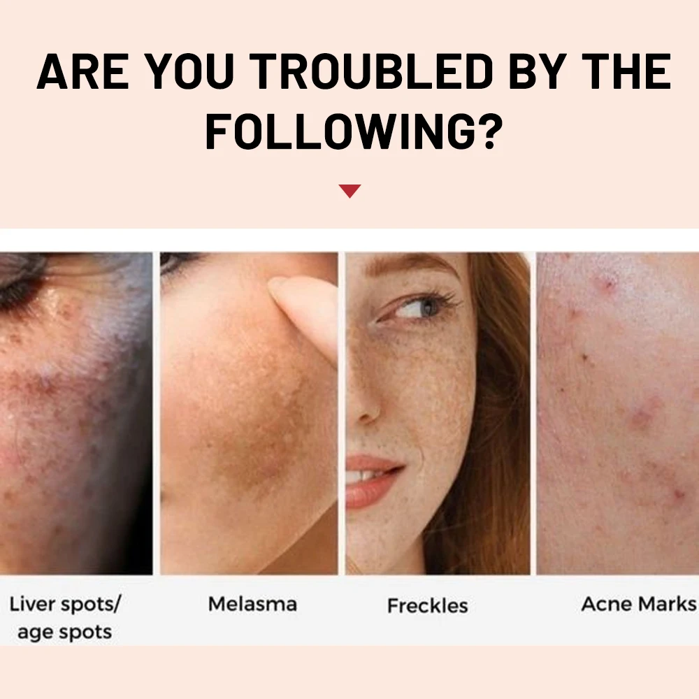Whitening Cream 7-day rapid freckle removal