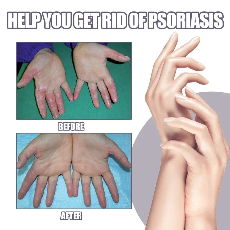 Hand Tinea Foot Odor beriberi spray Eczema Psoriasis Treatment Dermatitis Fungus Removal Relief itch deodorant skin repair care